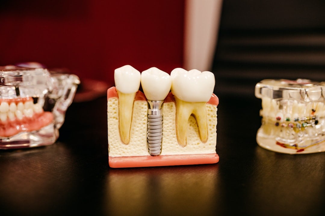 Dlaczego warto zainwestować w implanty zębowe?